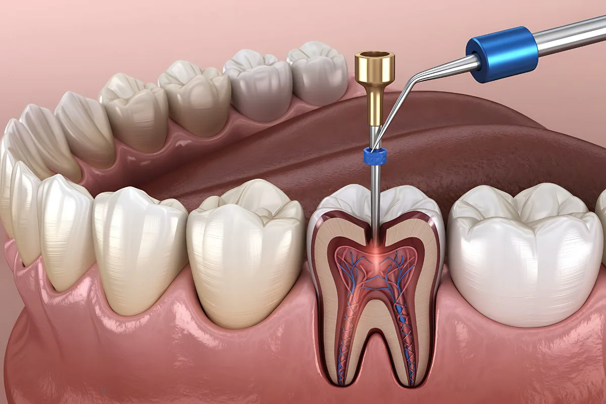 Diagnóstico clínico para tratamiento de endodoncia en Oraltek